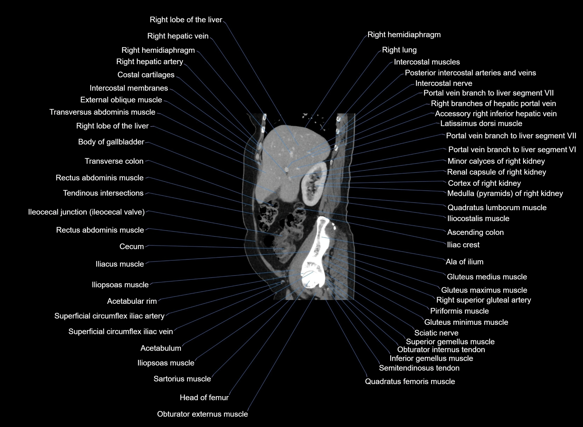 CT Abdomen sagittal cross sectional anatomy labelled radiology image -00083.webp